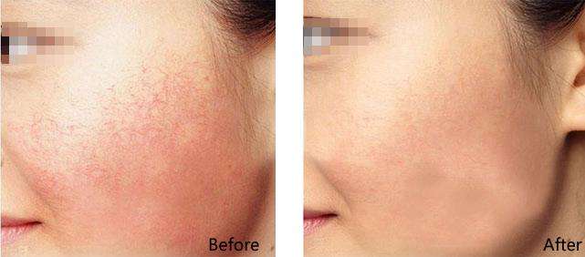 如何消除红血丝？从护肤到医美一篇给你讲透